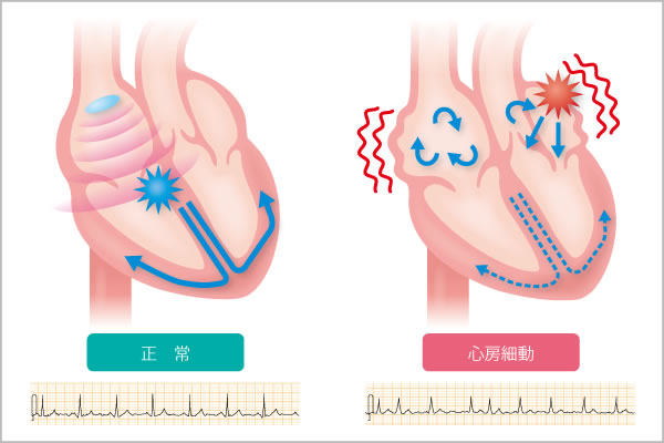 心房細動